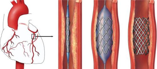 从心脏支架直降95%看中国医改